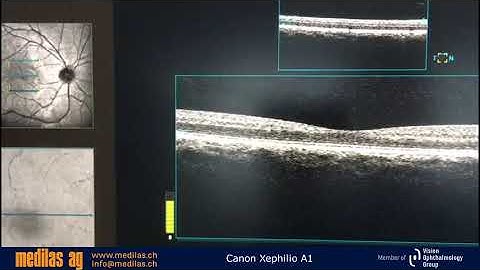 Canon Xephilio OCT A1 Anwendung