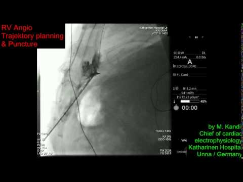 Dry Epicardial Access