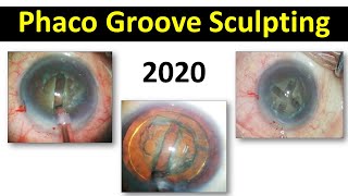 Phaco Groove Sculpting (phaco 1) - Basic phaco