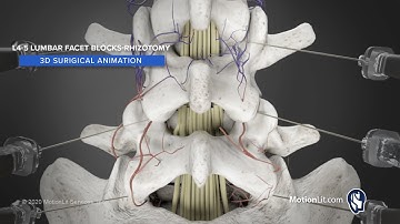 3D Animation of Lumbar Facet Rhizotomy Details Injection Procedure For Pain Relief