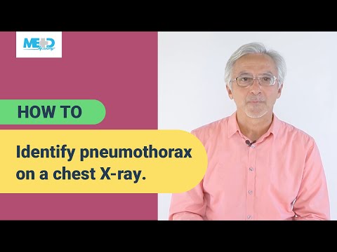 How to identify pneumothorax on a chest X-ray.