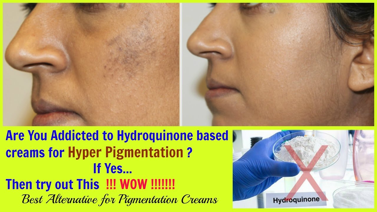 How to cure Hyper-Pigmentation and Dark Spots Permanently 