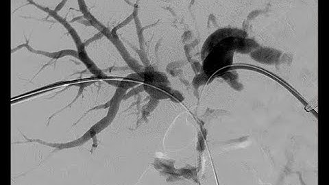 Percutaneous Transhepatic Cholangiography and Drainage (PTCD)