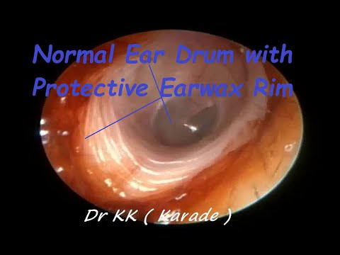 Normal Ear Drum