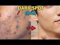 How To Remove DARK SPOTS From Face Naturally | ACNE SCARS, BLACK SPOTS, ACNE MARKS | Style Saiyan