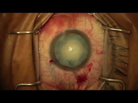 Surgery: Phacoemulsification in a Mature Liquefied Cataract: Dr. James Lehmann