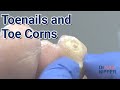 Toenails and Toe Corns. FEET-ure Friday  (2023)