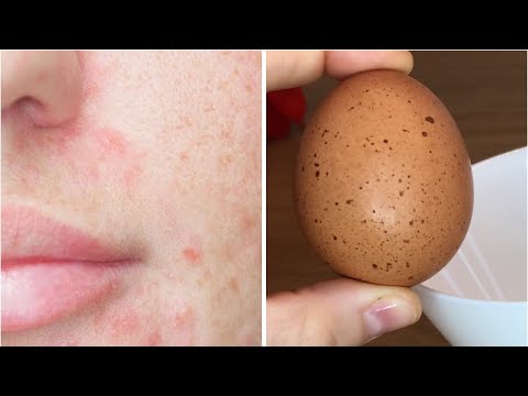 თუ გაქვთ პრობლემური კანი, ეს ვიდეო თქვენთვის არის, აჭრელება,გამონაყარი,ლაქები