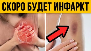 Эти симптомы СМЕРТЕЛЬНО ОПАСНЫ! / Самые НЕОЧЕВИДНЫЕ признаки инфаркта!