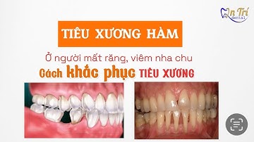 Tiêu xương hàm: Dấu hiệu, nguyên nhân và cách khắc phục | NHA KHOA AN TRÍ #drtrinhquangtri