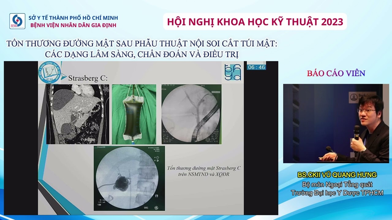TỔN THƯƠNG ĐƯỜNG MẬT SAU PHẪU THUẬT NỘI SOI CẮT TÚI MẬT: CÁC DẠNG LÂM SÀNG, CHẨN ĐOÁN VÀ ĐIỀU TRỊ