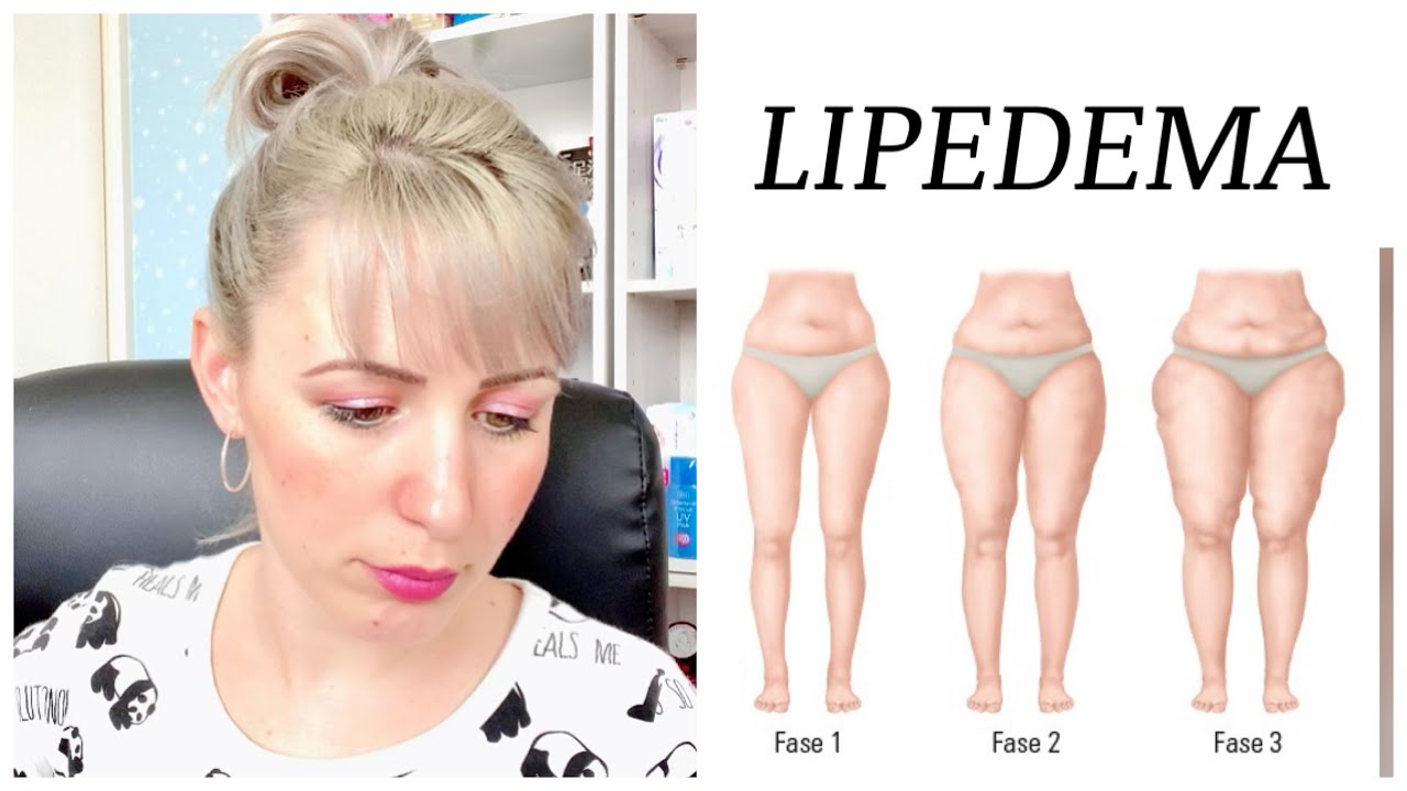 Tudo Sobre A Minha DoenÇa Lipedema Youtube