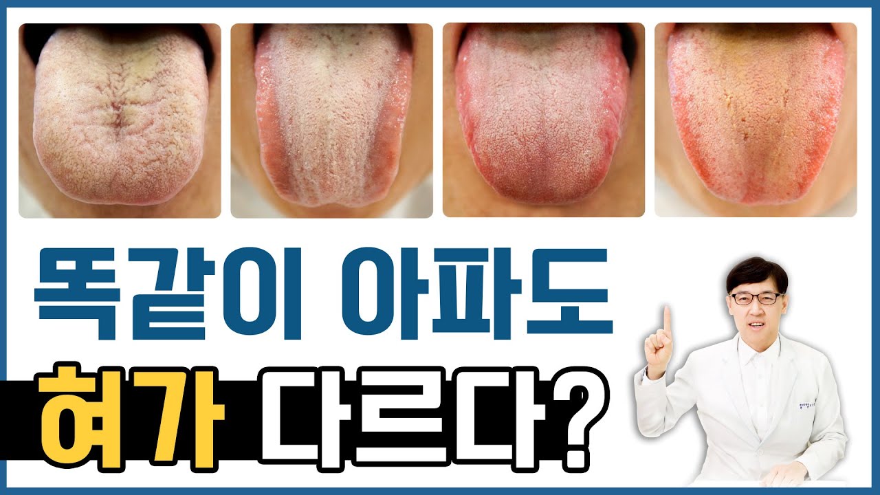 혀병원 한의사가 알려드리는 설진 혀진단법 - YouTube