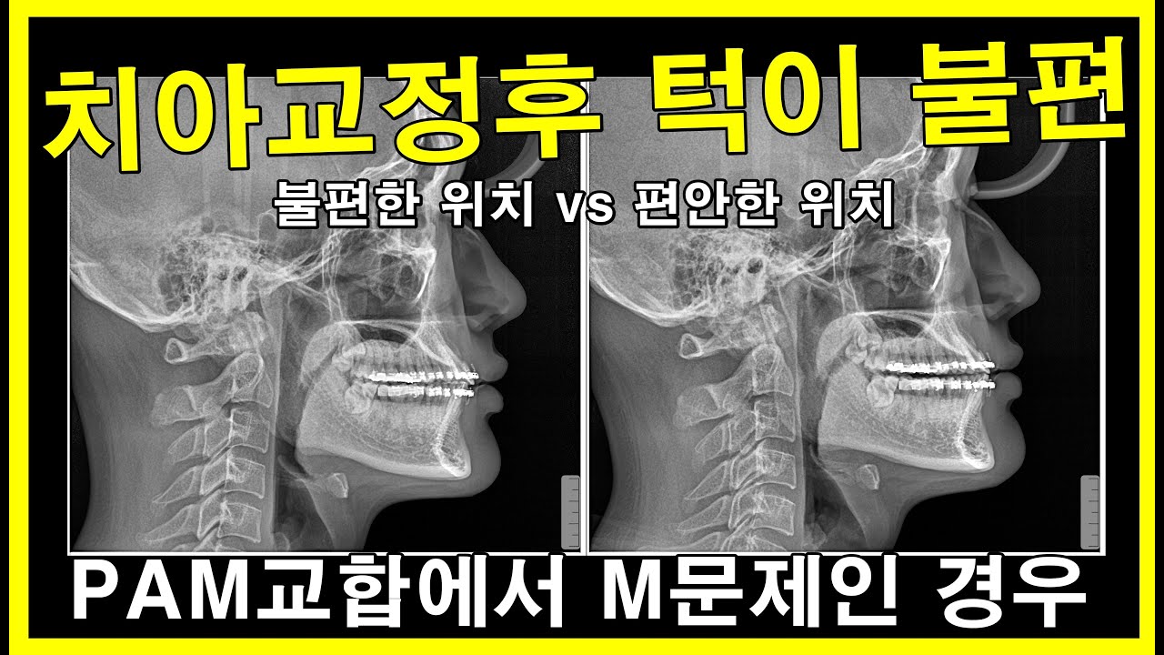 치아교정후 턱이 불편 #턱위치 #교정부작용 #Pamo / 턱위치에 대한 생각없이 치아배열만 하니까 이런 의료사고가 생김. 복구하기  어려움 - Youtube