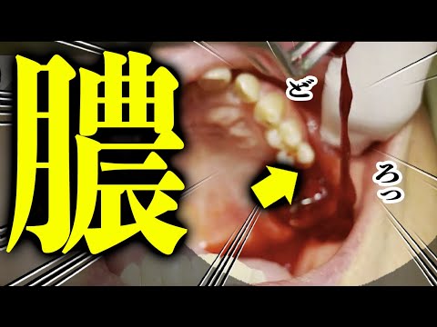 Pull out pus bag wobbly root periodontal disease