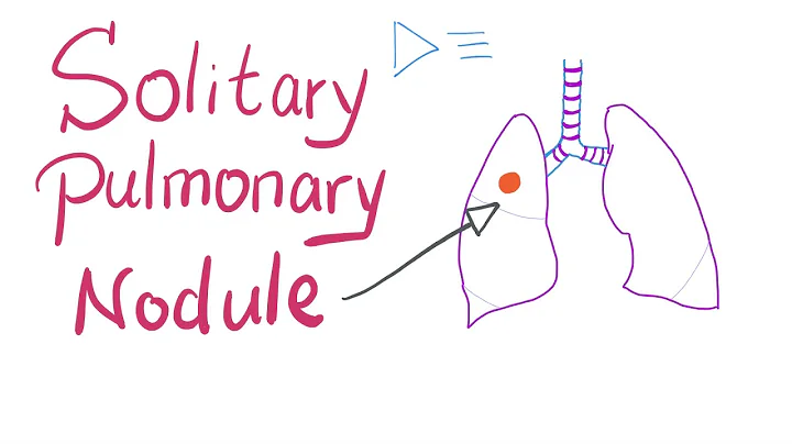 Solitary Pulmonary Nodule (SPN): How to manage it! - DayDayNews