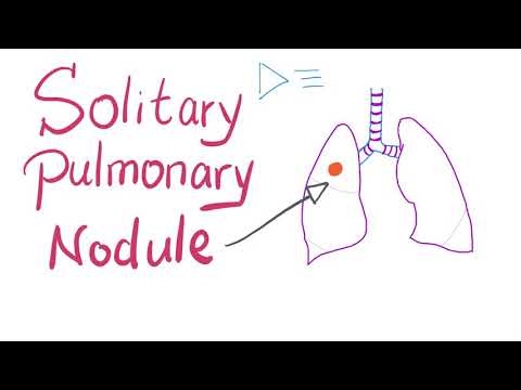 Nodul Pulmonar Solitar (SPN): Cum Să-l Gestionăm!