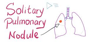 Solitary Pulmonary Nodule (SPN): How to manage it!