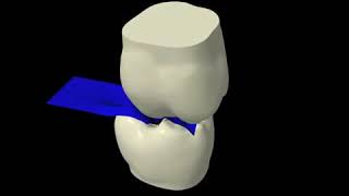 Control de la oclusión con el método de las 2 fases