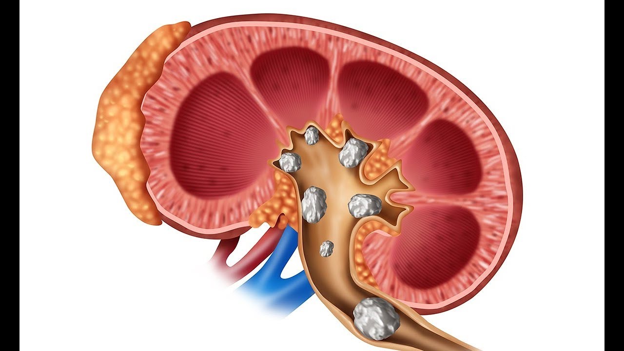 Мочекаменная болезнь макропрепарат. Показатели для почечнокаменной болезни. Нефролитиаз почек симптомы и лечение. Локализация камней в почках. Мочекаменная болезнь классификация.