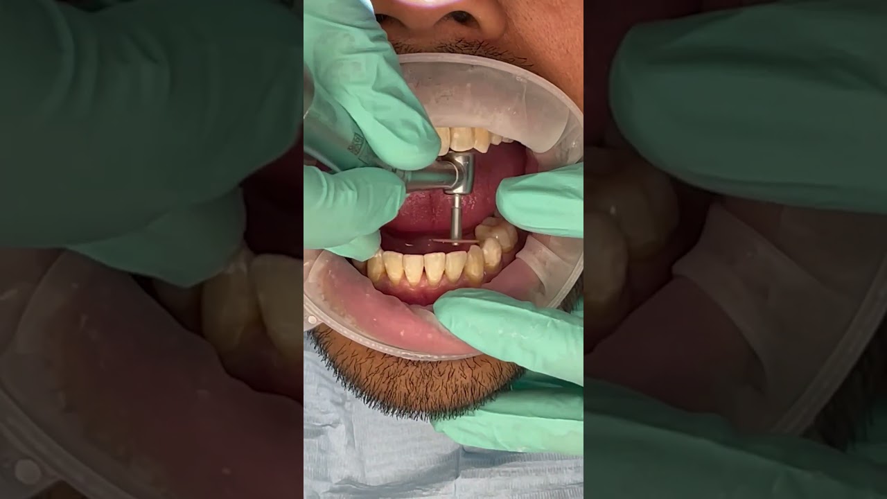 Taking off braces after 4 years 