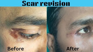 Scar revision surgery| Result of scar revision surgery| Best scar treatment in India #scar