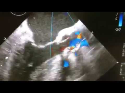 Операция Озаки в Институте Сердца  Пациентке 82 года  Критический аортальный стеноз