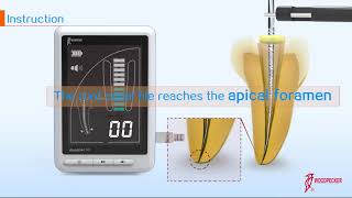 How To Use Woodpecker Apex Locator Woodpex Iii Www Mydentcart Com