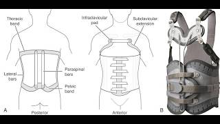 Thoracolumbosacral orthosis TLSO; spinal brace to support and stabilize thoracic, lumbar, and sacral