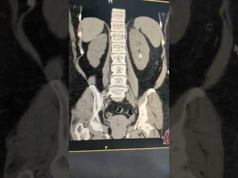 CT KUB with stone protocol in radiology #medical #NCCT