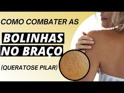 Vídeo: Borlas de plantas de milho - razões pelas quais as borlas de milho são muito cedo