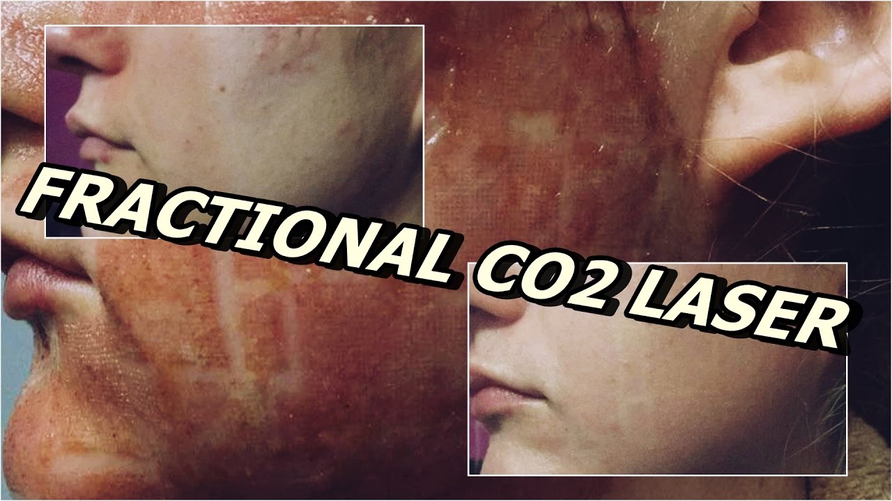 ACNE SCARS - FRACTIONAL CO2 LASER (7days) - YouTube