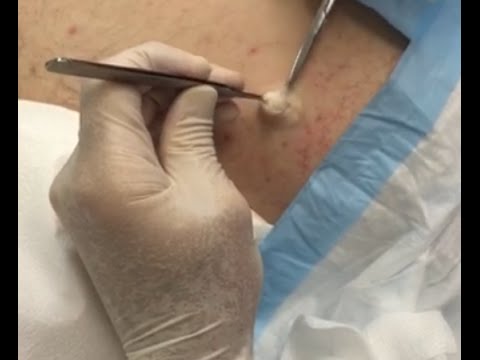 What A Beauty!  Snowy White Sebaceous Cyst Begs To Be Seen & Loved!