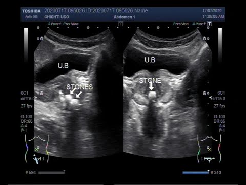 prostatic calculi ultrasound)