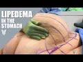 Lipedema in the stomach  treating lipedema in the abdomen  total lipedema care