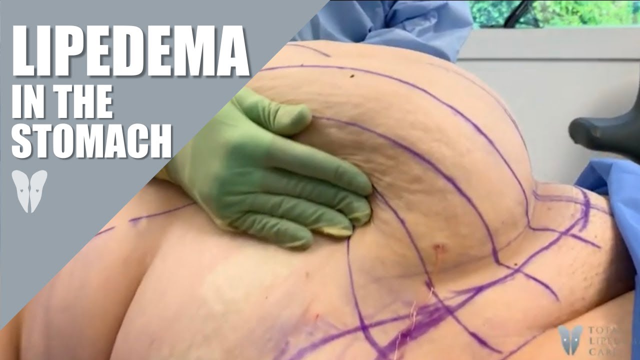 Lipedema in the Stomach | Treating Lipedema in the Abdomen | Total Lipedema Care