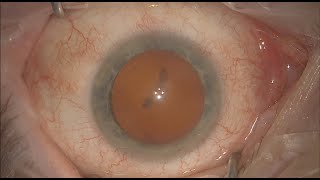 Modern Cataract with only numbing drops