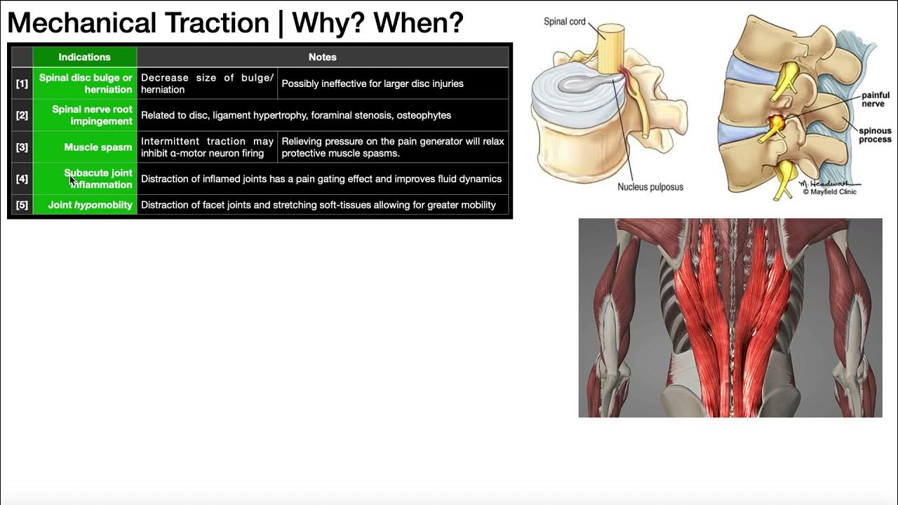 Mechanical Traction [Part 1] Theory, Indications & Contraindications