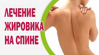 Лечение жировика на спине(Липома – это доброкачественная опухоль. Часто у многих людей и на разных частях тела появляются подкожные..., 2016-01-20T12:56:32.000Z)