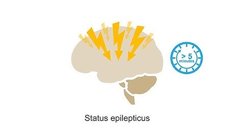 Managing status epilepticus–Neurology Masterclass