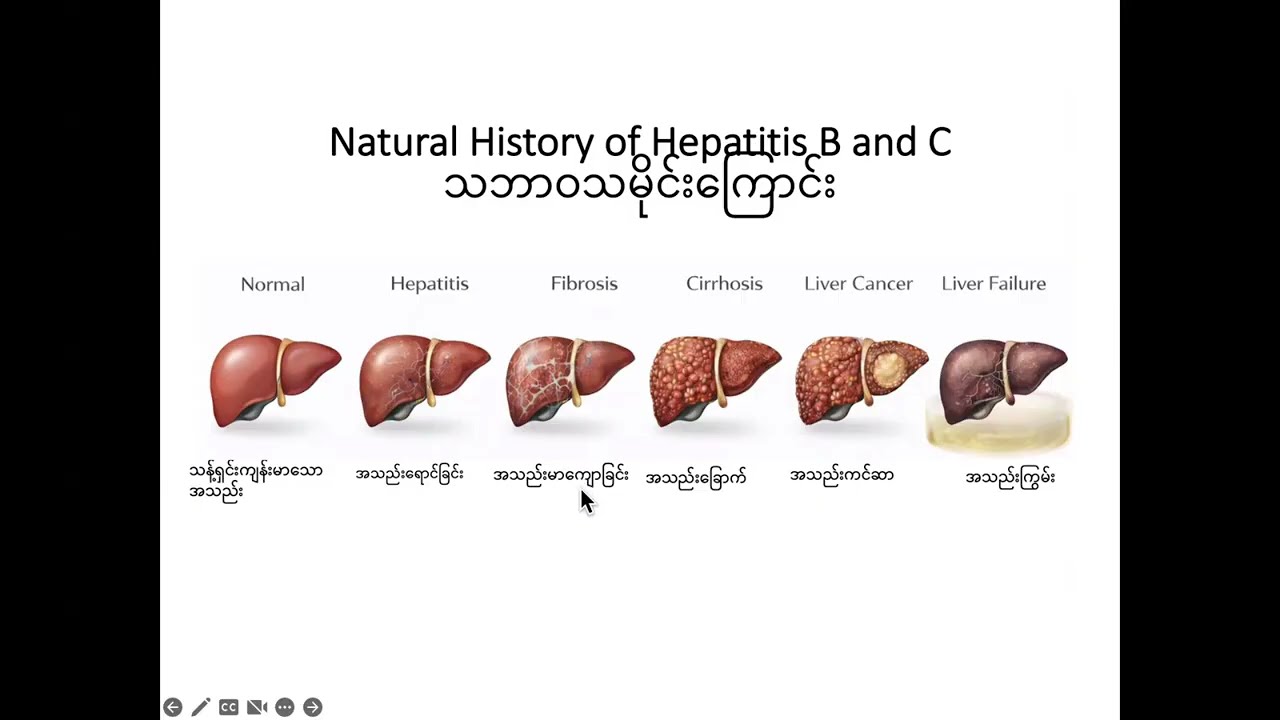 Preventive Medicine 3A:အသည်းကို တိတ်တဆိတ် ပျက်စီးစေနိုင်တဲ့ Viral Hepatitis B & C ကူးစက်ပုံစစ်ဆေးမှု