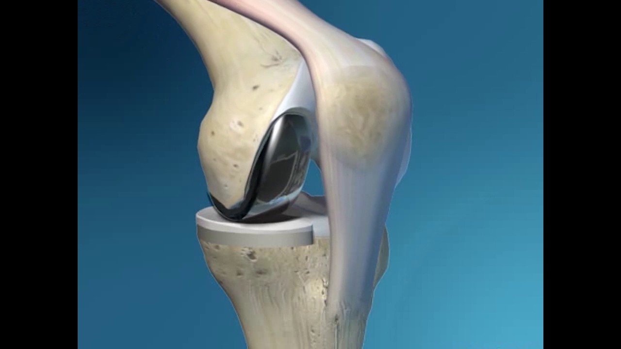 Protesi Al Ginocchio Centri Di Eccellenza Roma Protesi di Ginocchio Parziale - https://protesidiginocchio.net - YouTube