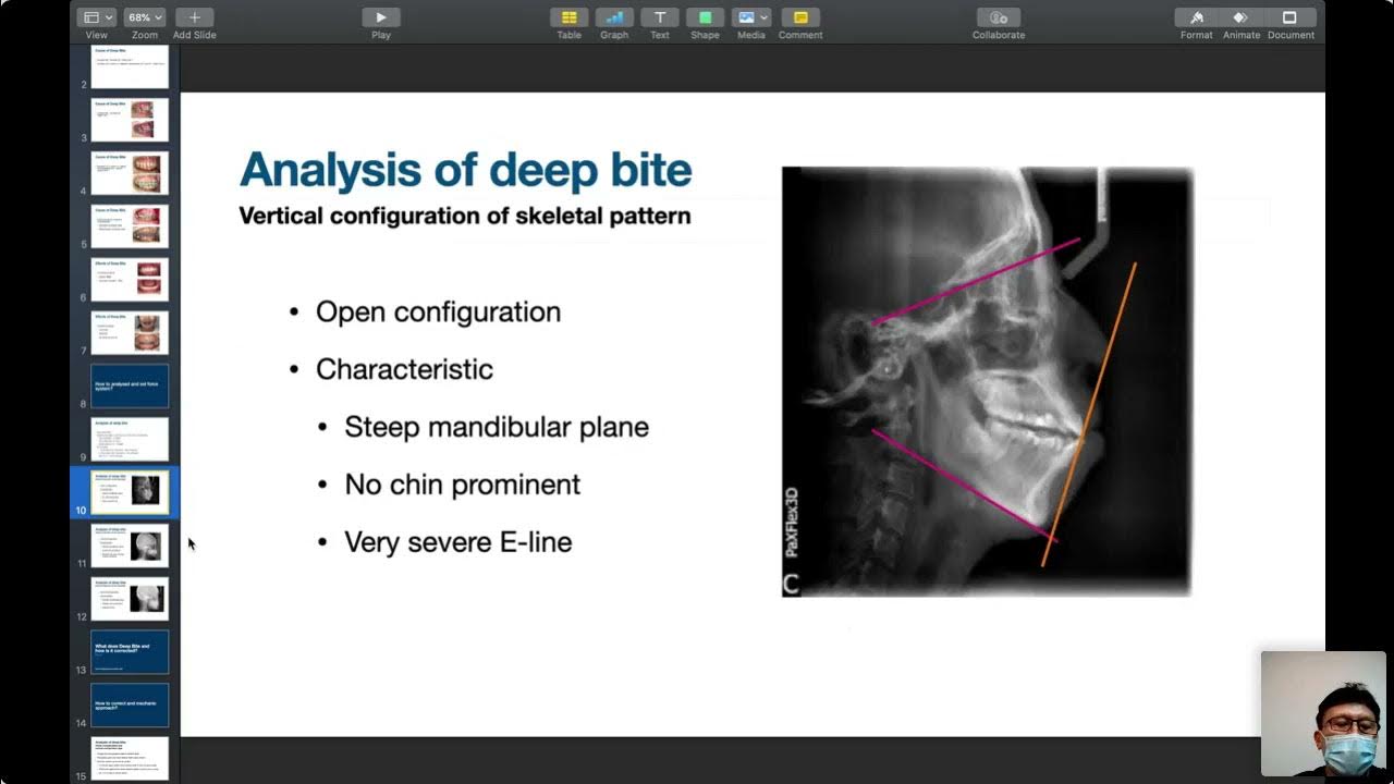 สัมมนาออนไลน์ ครั้งที่ 5 What does Deep Bite mean and how is it