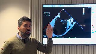 Mitral Valve Prolapse Analysis; 2D/3D-TEE step-by-step approach