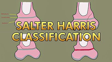 Salter Harris Classification for Pediatric Growth Plate Fractures
