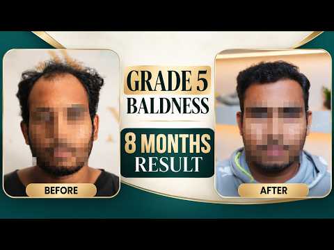 Grade 5 Baldness Transformation 😮 | 8-Month Results | Hair Transplant in Pune | Marathi