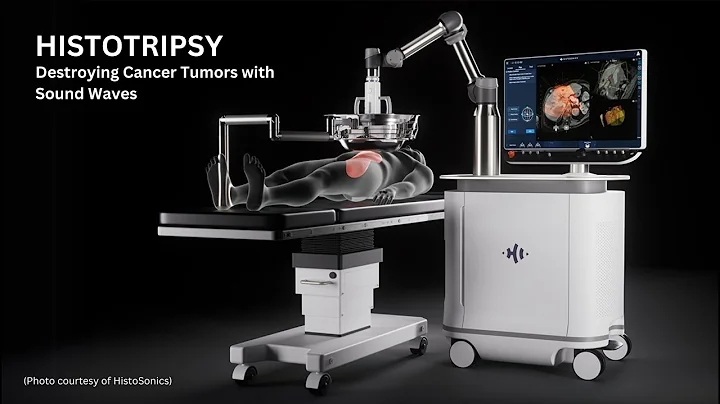 Histotripsy destroying cancer tumors with sound waves