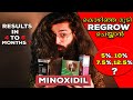 കൊഴിഞ്ഞ മുടി തിരിച്ചു കൊണ്ടുവരാം | Hair Regrowth | Minoxidil | Baldness Cure | LHG