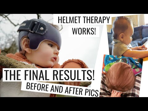 Flat Head Syndrome| Helmet Therapy|Final Results|Plagiocephaly|Brachycephaly