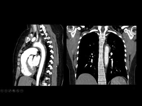 Vídeo: O Monitoramento Do Infliximabe Plasmático Contribui Para Otimizar O Tratamento Da Arterite De Takayasu: Relato De Caso